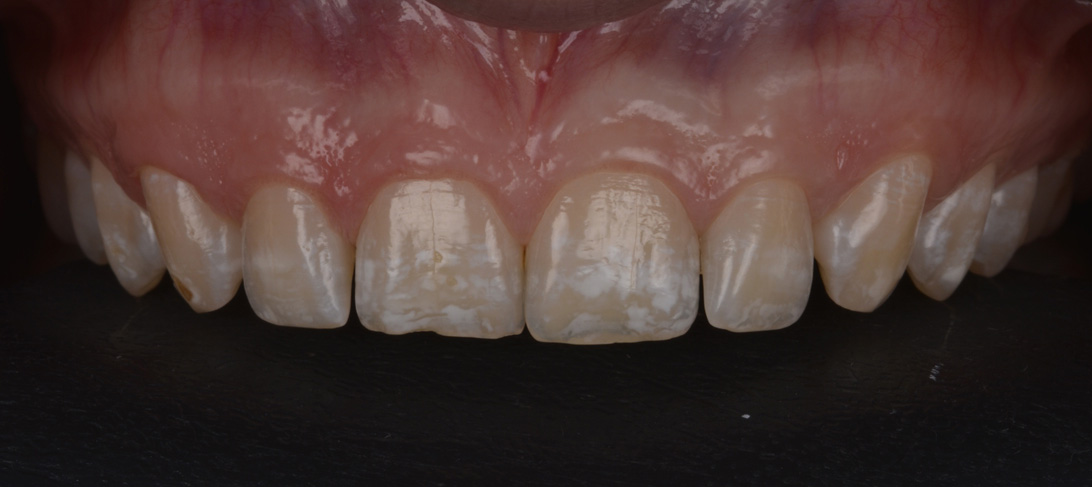 Diagnóstico de fluorose em grau moderado com presença de manchas mais intensas entre os dentes 13 ao 23.