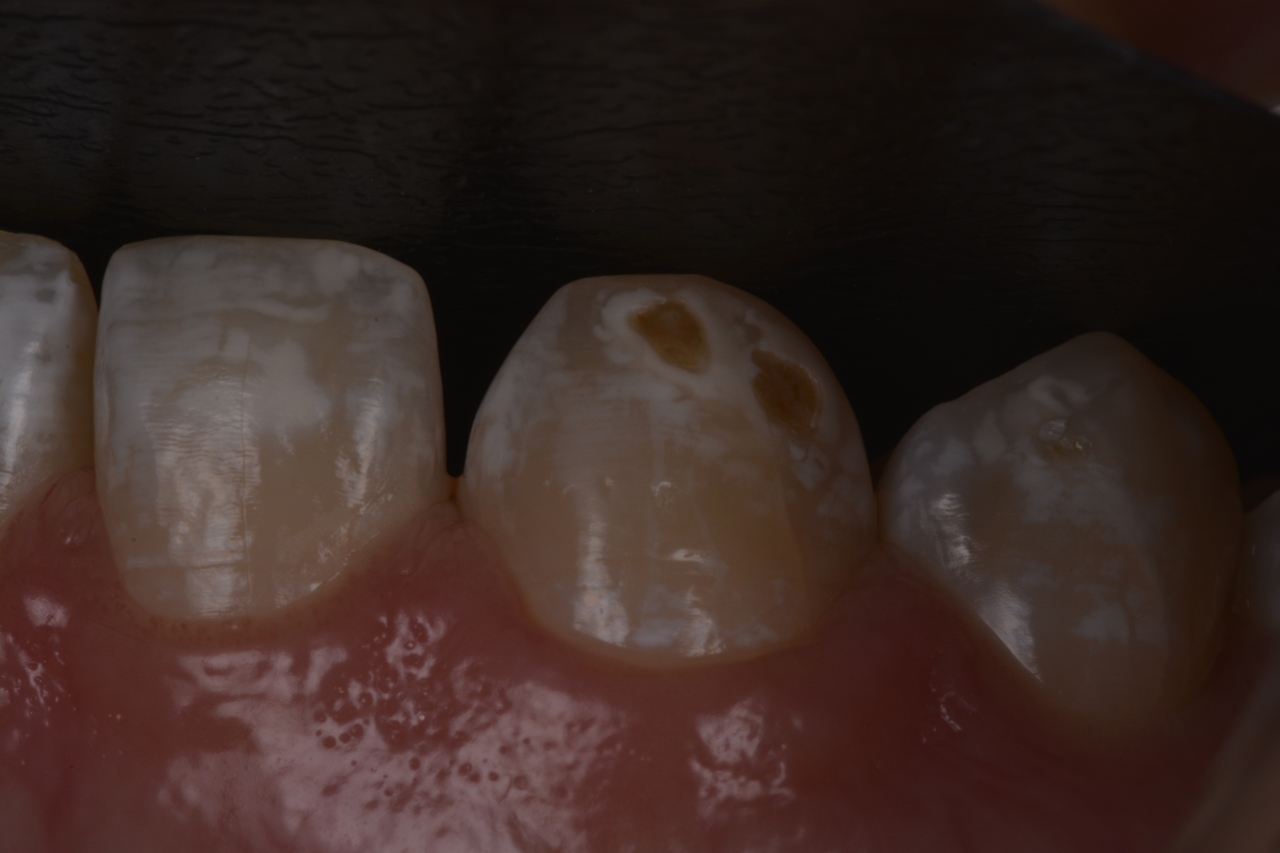 Aspecto do dente 13 antes e e após a transiluminação. Na ponta de cúspide é perceptível uma hipoplasia mais profunda.