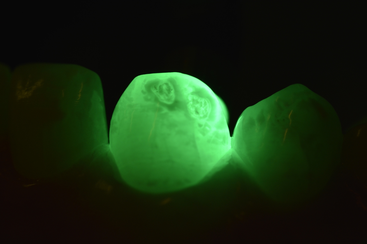 Aspecto do dente 13 antes e e após a transiluminação. Na ponta de cúspide é perceptível uma hipoplasia mais profunda.
