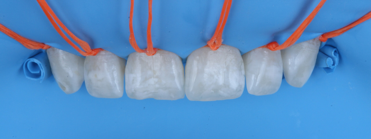 Amarras em todos os dentes a serem microabrasionados, conferindo proteção adicional aos tecidos gengivais.