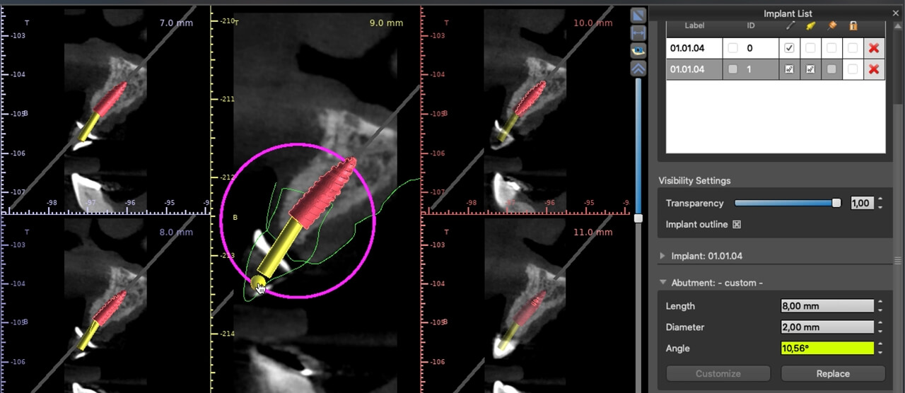 Fig. 15 – Planejamento virtual dos implantes Arcsys. Observar a personalização do ângulo de emergência dos componentes protéticos em relação aos implantes (10,56°).