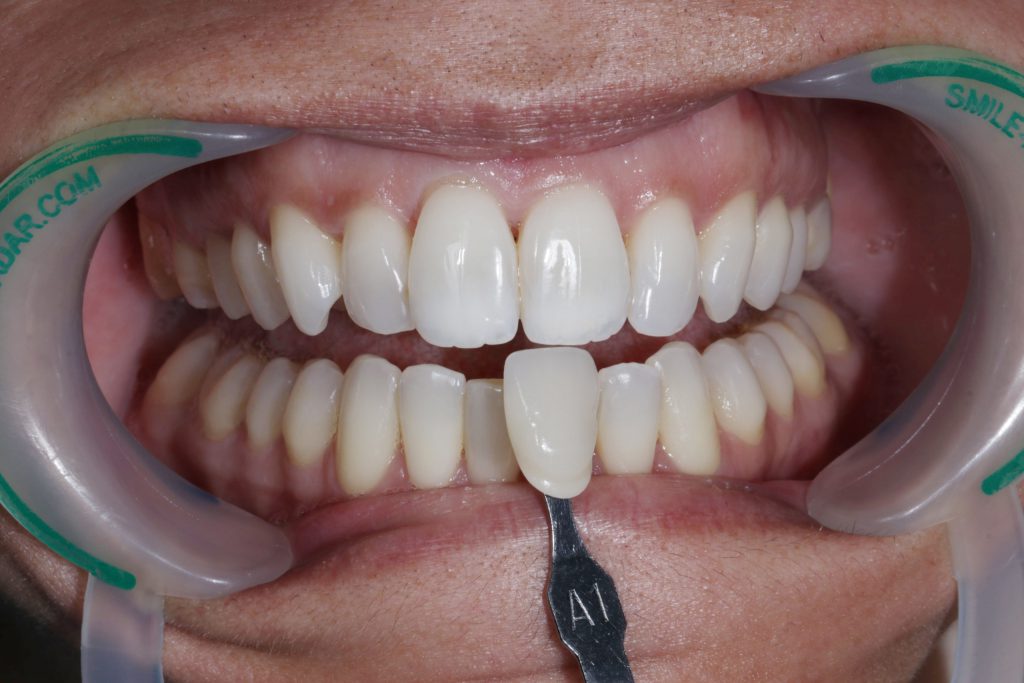 IMG 4337 min scaled 1 - Aclarecimiento dental mediante la técnica combinada utilizando Whiteness HP AutoMixx 6% y Whiteness Perfect 16%