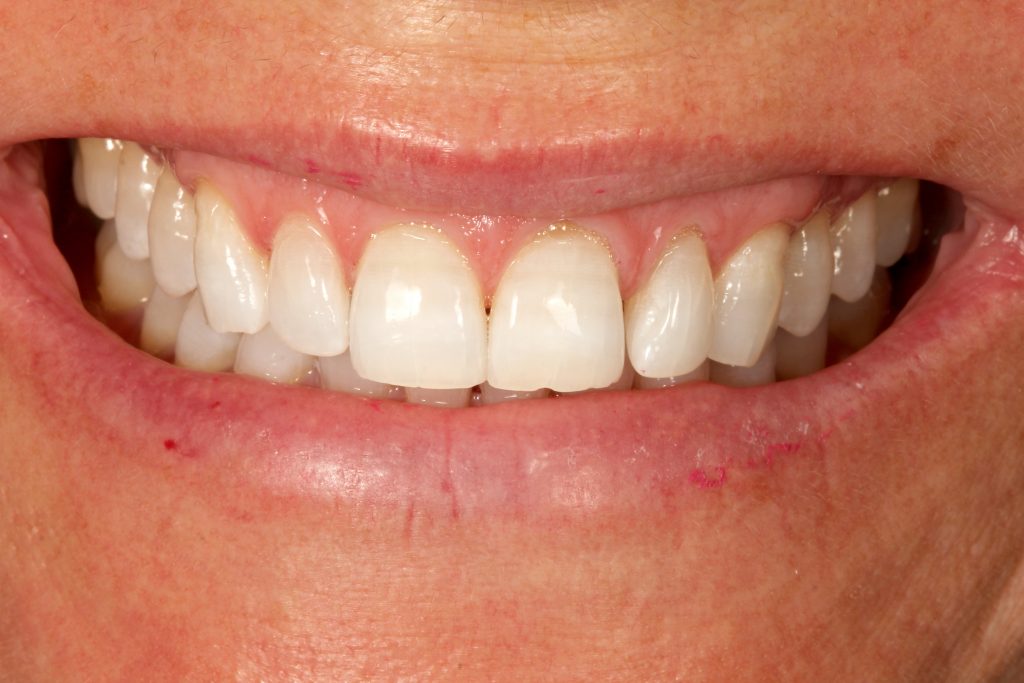 8 min1 - Overcoming challenges in teeth whitening: tetracycline staining.