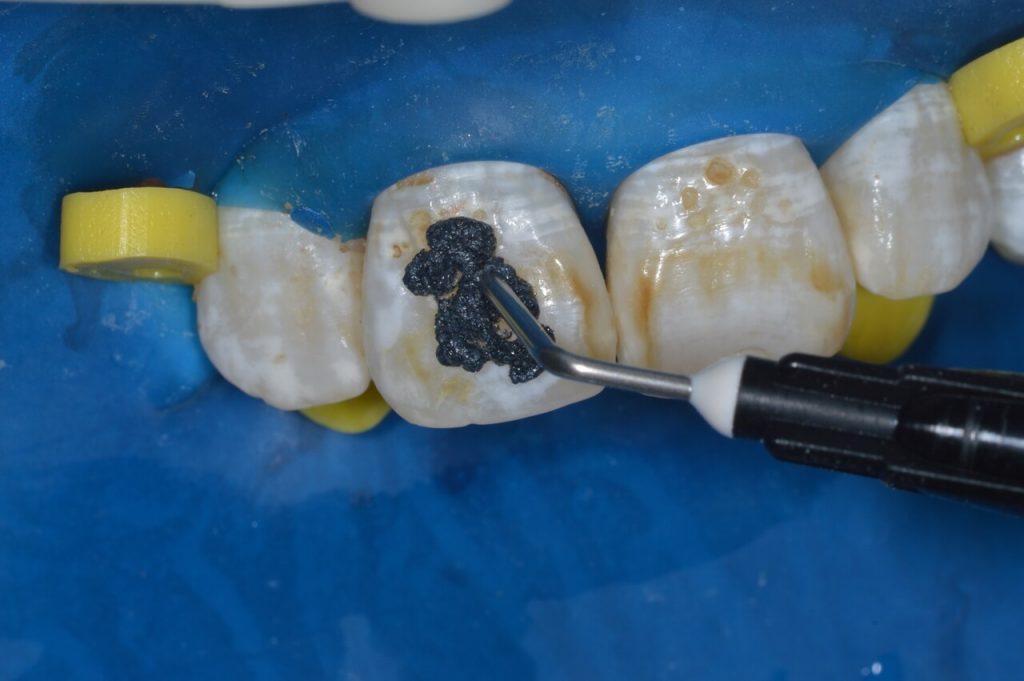 Figura12 DSC 02541 - Soluciones poco invasivas para casos de fluorosis dental: microabrasión y aclaramiento