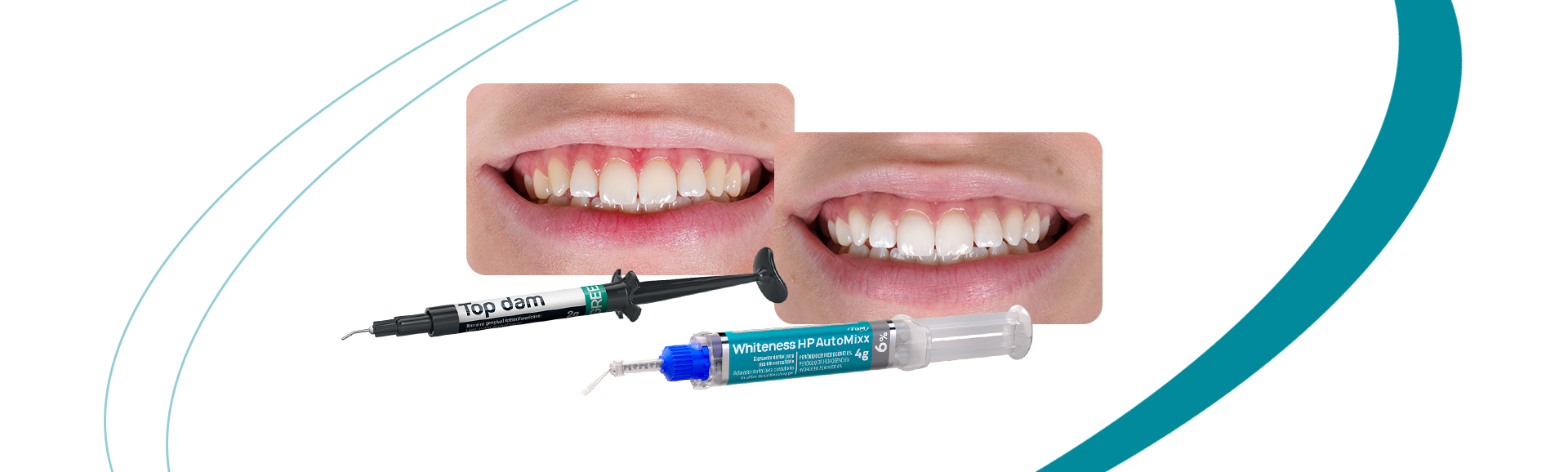 Capa clareamento automixx6 jovem - In-office whitening with Whiteness HP Automixx 6% with brush tip