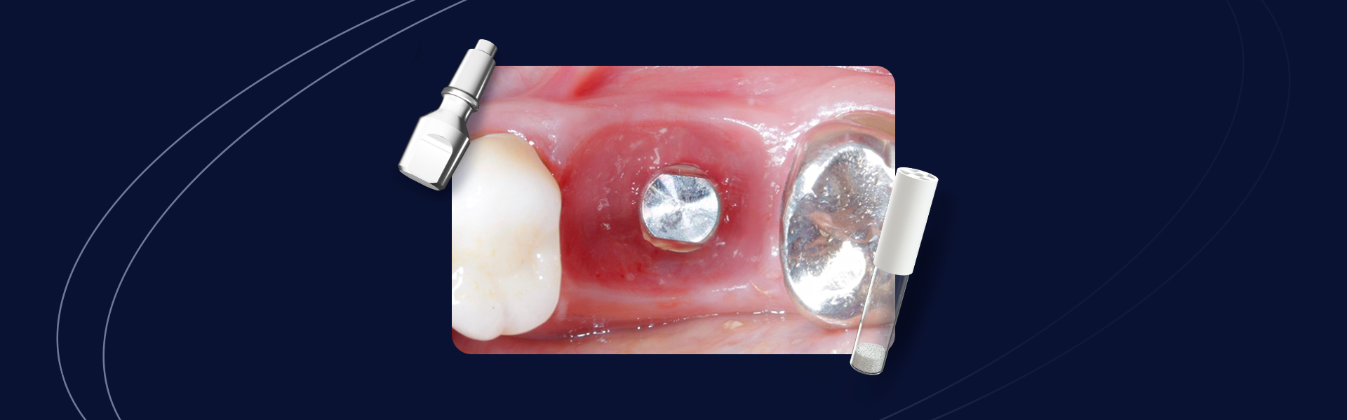 Capa Fluxo Caso - Implante Imediato Arcsys em molar inferior